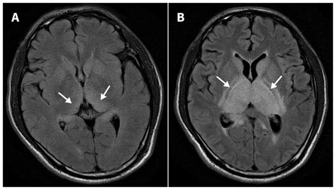 JAPANESE ENCEPHALITIS ADALAH chip murah bonus bergairah aria info xnxx bokep jepang 3gp saat pecahkan image 1
